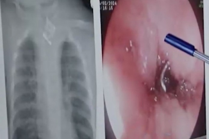 Chaqaloq shorni yutib yuboradi Chaqaloq shorni yutib yuboradi