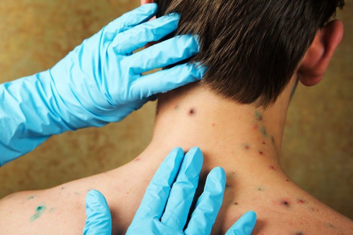 Suvchechak kattalarda nega og‘ir kechadi?