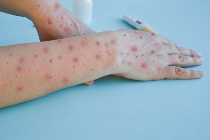 O'zbekistonda yosh bolalar orasida yangi virus tarqaldimi?