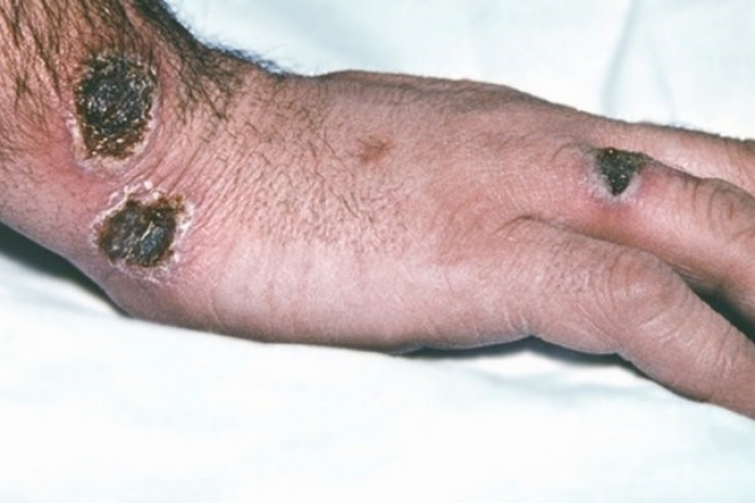 Sirdaryoda fuqarolarning birida Sibir yarasi (kuydirgi) kasalligi aniqlanganligi rad etildi