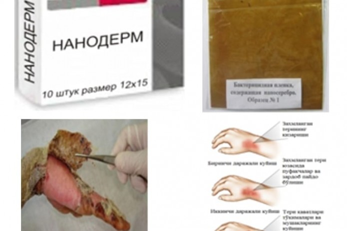 O‘zbekistonda kuygan yara va chuqur yaralarni davolovchi "Nanoderm" - implant-plyonkalari shakllantirildi