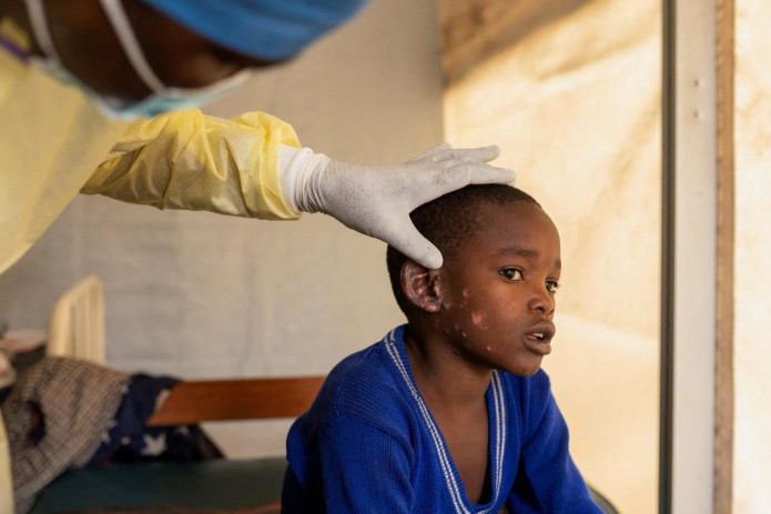 JSST maymunchechak epidemiyasiga qarshi kurashish uchun ko'rsatmalarni tasdiqladi