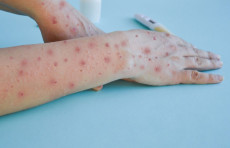 O'zbekistonda yosh bolalar orasida yangi virus tarqaldimi?